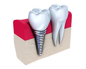 Dental Implants